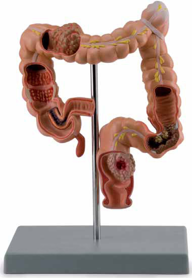 Pathological Model of Colon and Rectum